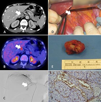 Case Report: Abdominal Lymph Node Metastases of Parathyroid Carcinoma: Diagnostic Workup, Molecular Diagnosis, and Clinical Management